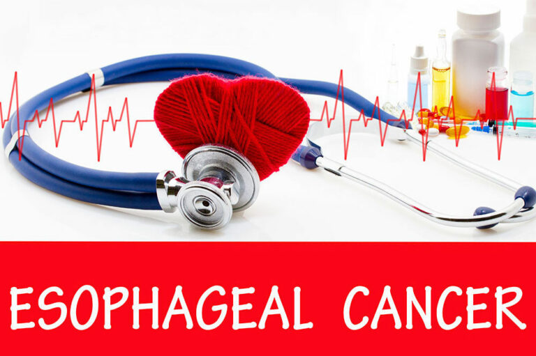 Esophageal cancer – Signs, causes, and management